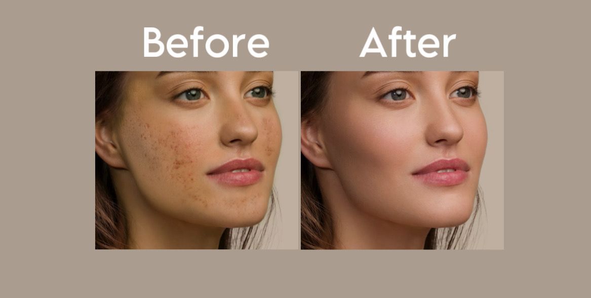 ACNE & SEBUM CONTROL