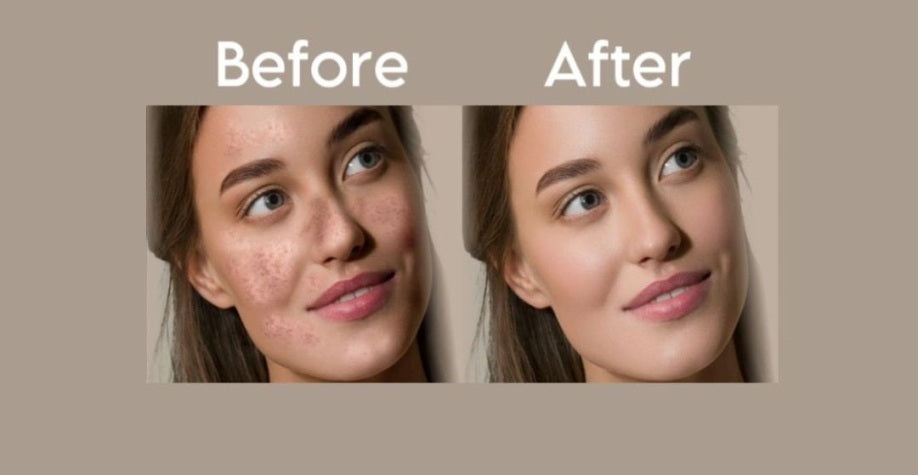 Say Goodbye to PIGMENTATION: A Journey towards Flawless Skin